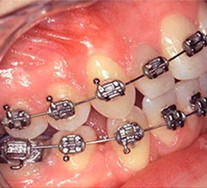 Clínica Dental Rodolfo Pita dientes con brackets